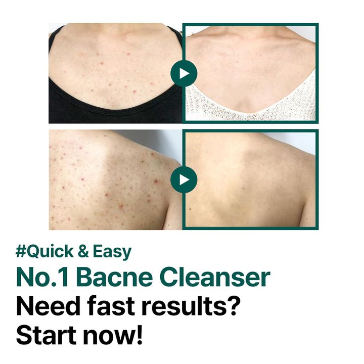 some-by-mi-clear-body-cleanser-400ml-aknes-samkurnalo-shkhapis-geli-photo-3