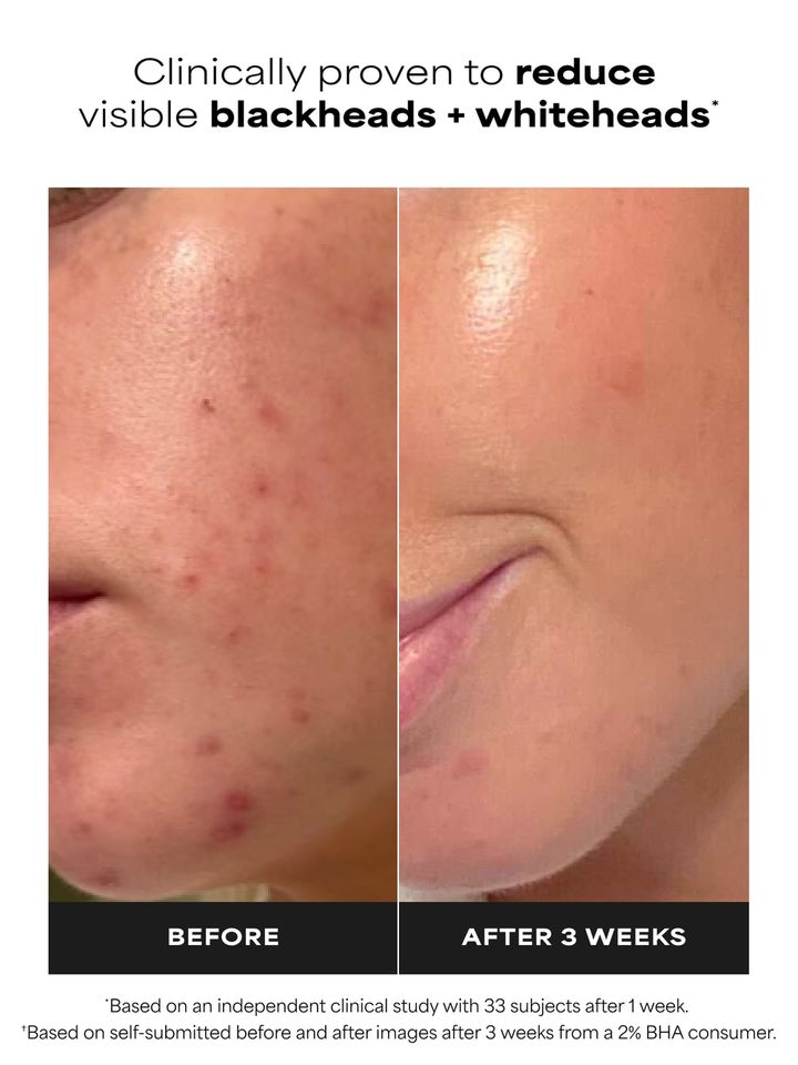 paulas-choice-skin-perfecting-2-bha-liquid-sakhis-gatsmenda-photo-2
