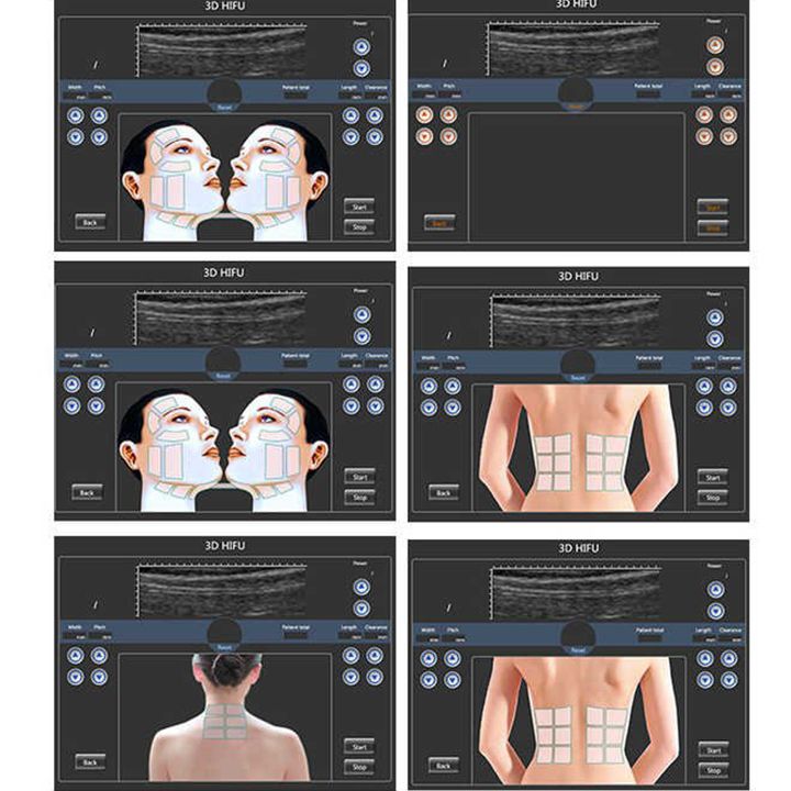 ulterapiis-aparati-3d-hifu-photo-2