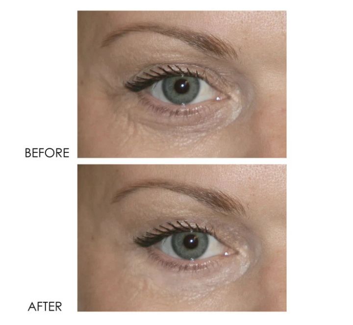 dermelect-revitalit-eyelid-dark-circle-corrector-tvalis-koreqtori-photo-3