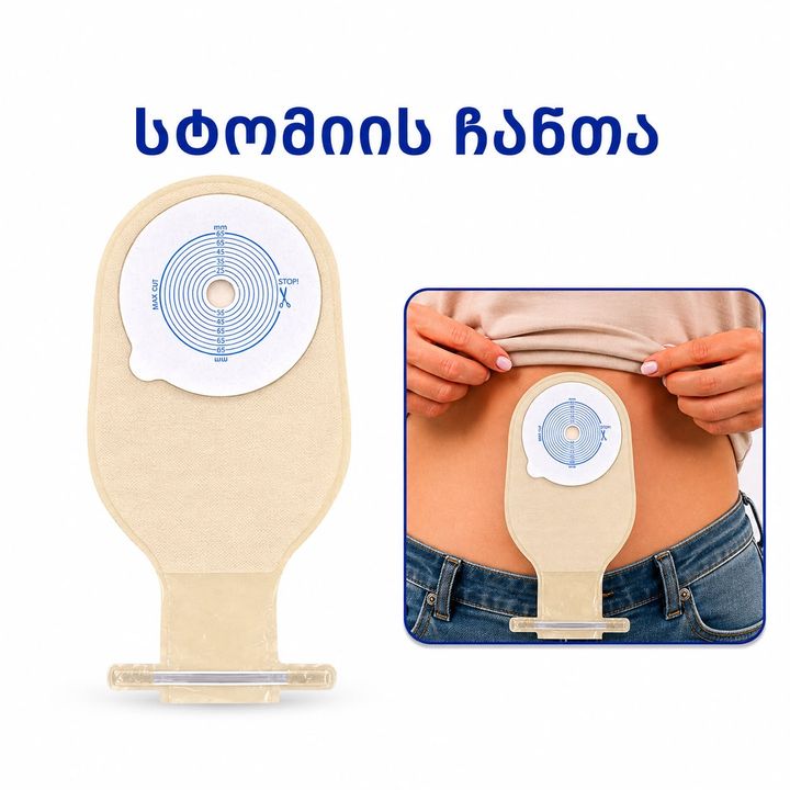 stomas-parki